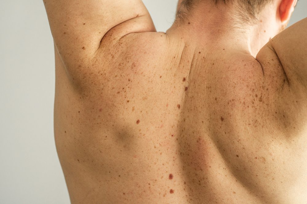 Kadınlarda bacak, erkeklerde sırt: Melanomda dikkat çeken fark 1 946