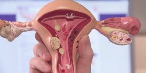 Miyomlar, rahim kas dokusundan gelişen iyi huylu tümörlerdir. Kansere dönüşme